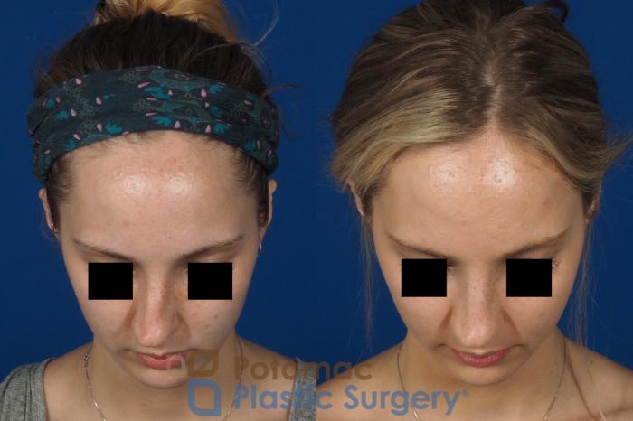 Before & After Rhinoplasty - Cosmetic Case 270 Top View in Washington DC & Arlington , DC
