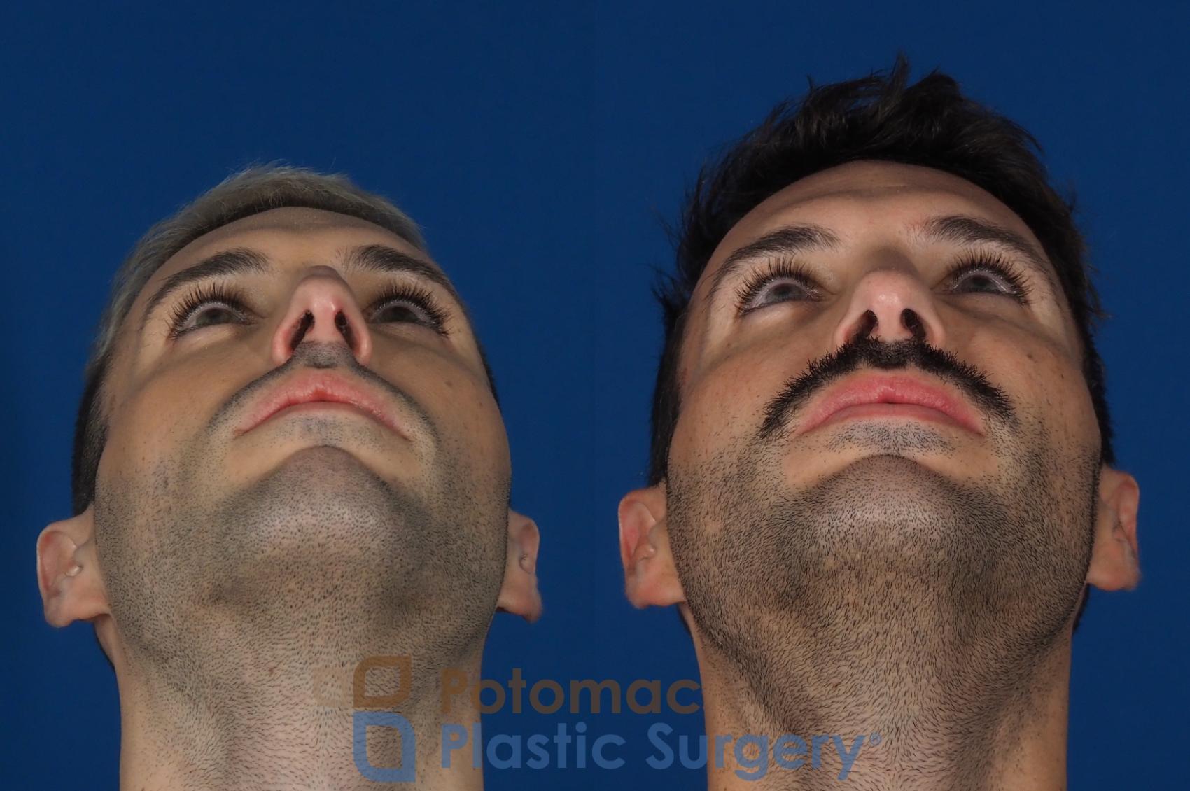 Before & After Rhinoplasty - Cosmetic Case 271 Bottom View in Washington, DC