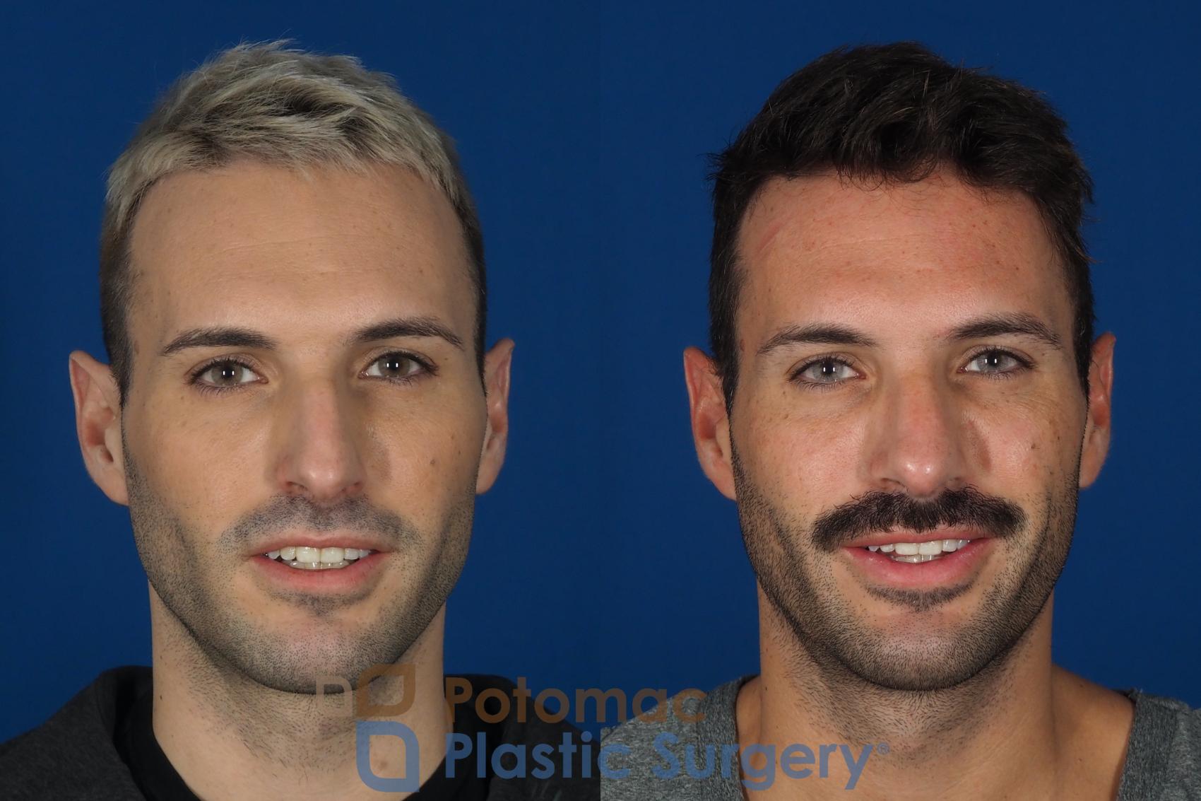 Before & After Rhinoplasty - Cosmetic Case 271 Front - Smiling View in Washington, DC