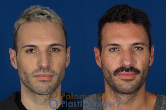 Before & After Rhinoplasty - Cosmetic Case 271 Front View in Washington, DC