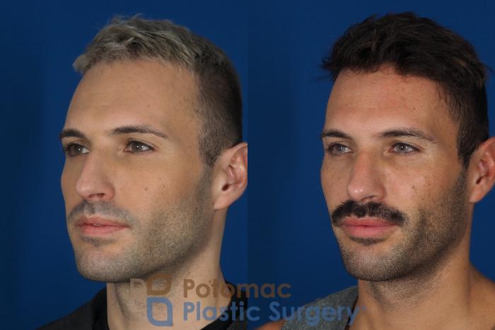Before & After Rhinoplasty - Cosmetic Case 271 Left Oblique View in Washington, DC