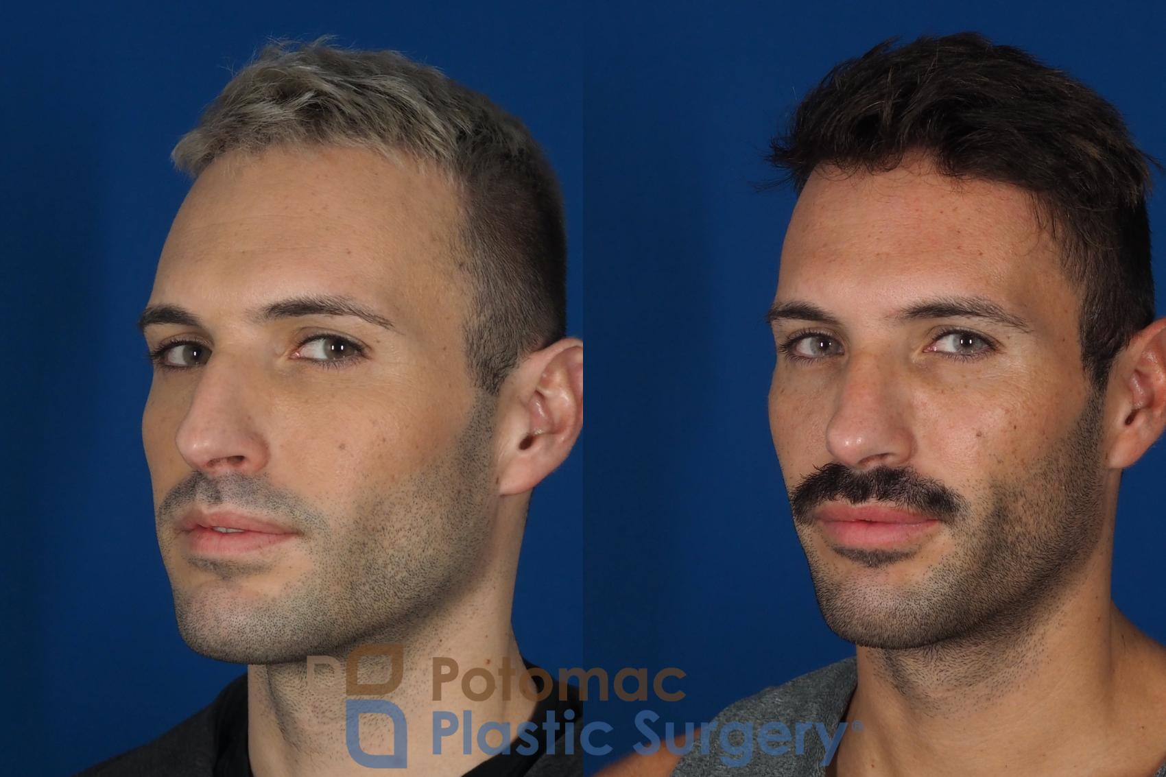 Before & After Rhinoplasty - Cosmetic Case 271 Left Oblique View #2 View in Washington, DC