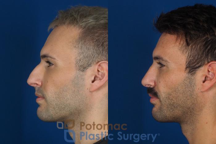 Before & After Rhinoplasty - Cosmetic Case 271 Left Side View in Washington, DC