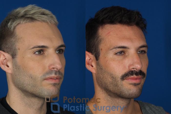 Before & After Rhinoplasty - Cosmetic Case 271 Right Oblique View in Washington, DC