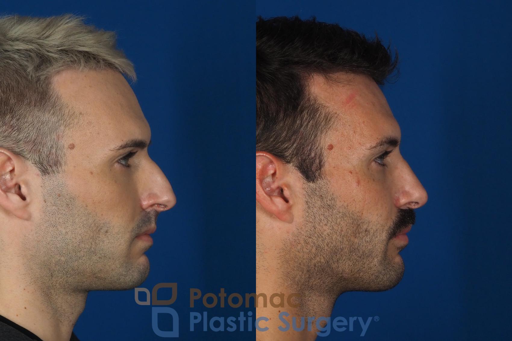 Before & After Rhinoplasty - Cosmetic Case 271 Right Side View in Washington, DC