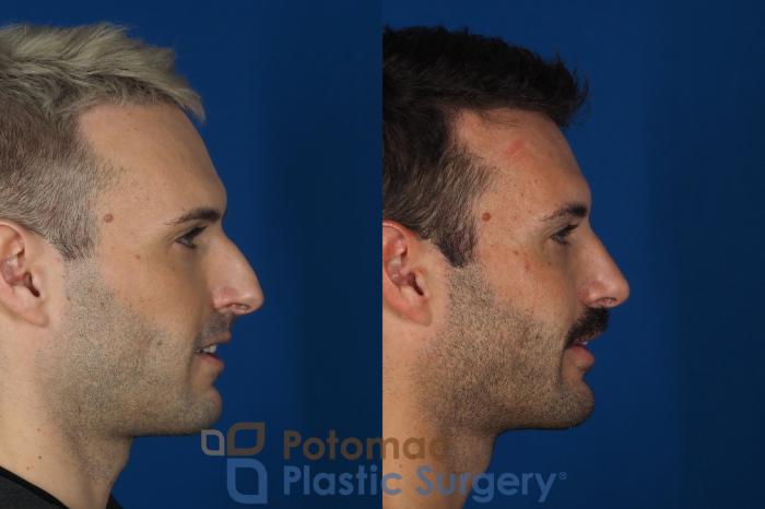 Before & After Rhinoplasty - Cosmetic Case 271 Right Side - Smiling View in Washington, DC