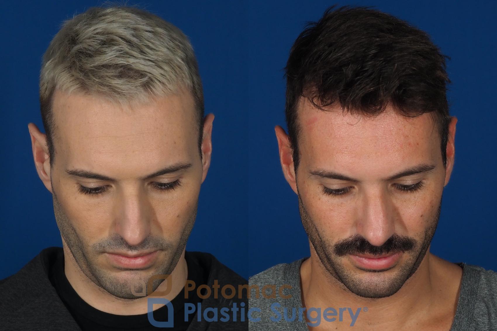 Before & After Rhinoplasty - Cosmetic Case 271 Top View in Washington, DC