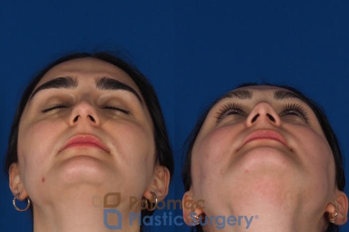 Before & After Rhinoplasty - Cosmetic Case 283 Bottom View in Washington, DC