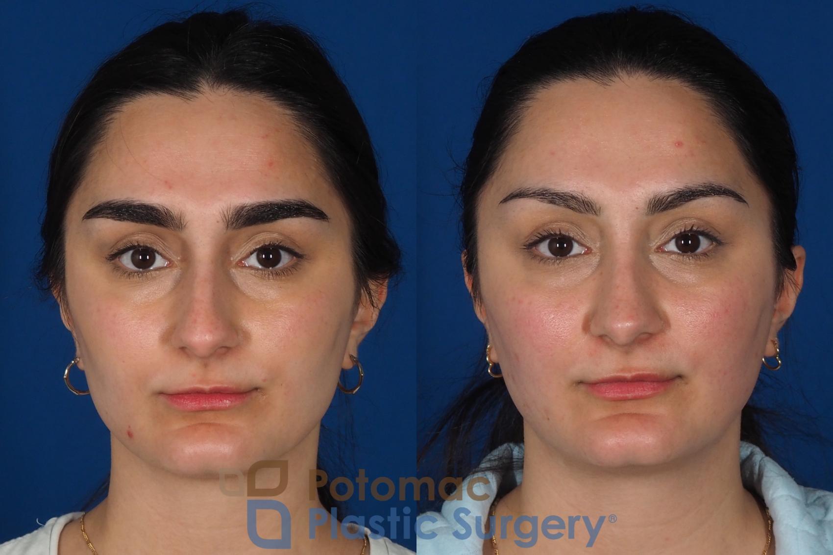 Before & After Rhinoplasty - Cosmetic Case 283 Front View in Washington, DC