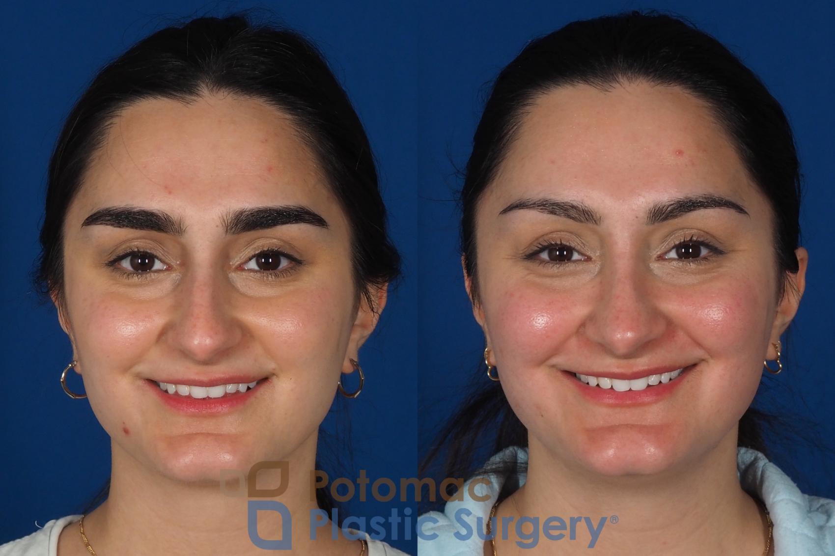 Before & After Rhinoplasty - Cosmetic Case 283 Front - Smiling View in Washington, DC