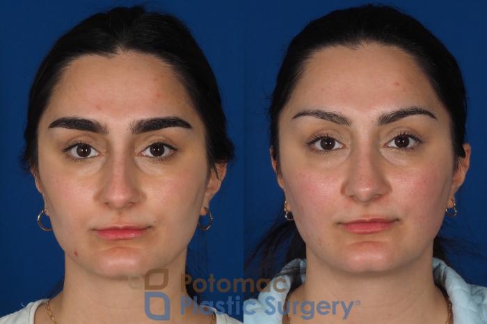 Before & After Rhinoplasty - Cosmetic Case 283 Front View in Washington, DC