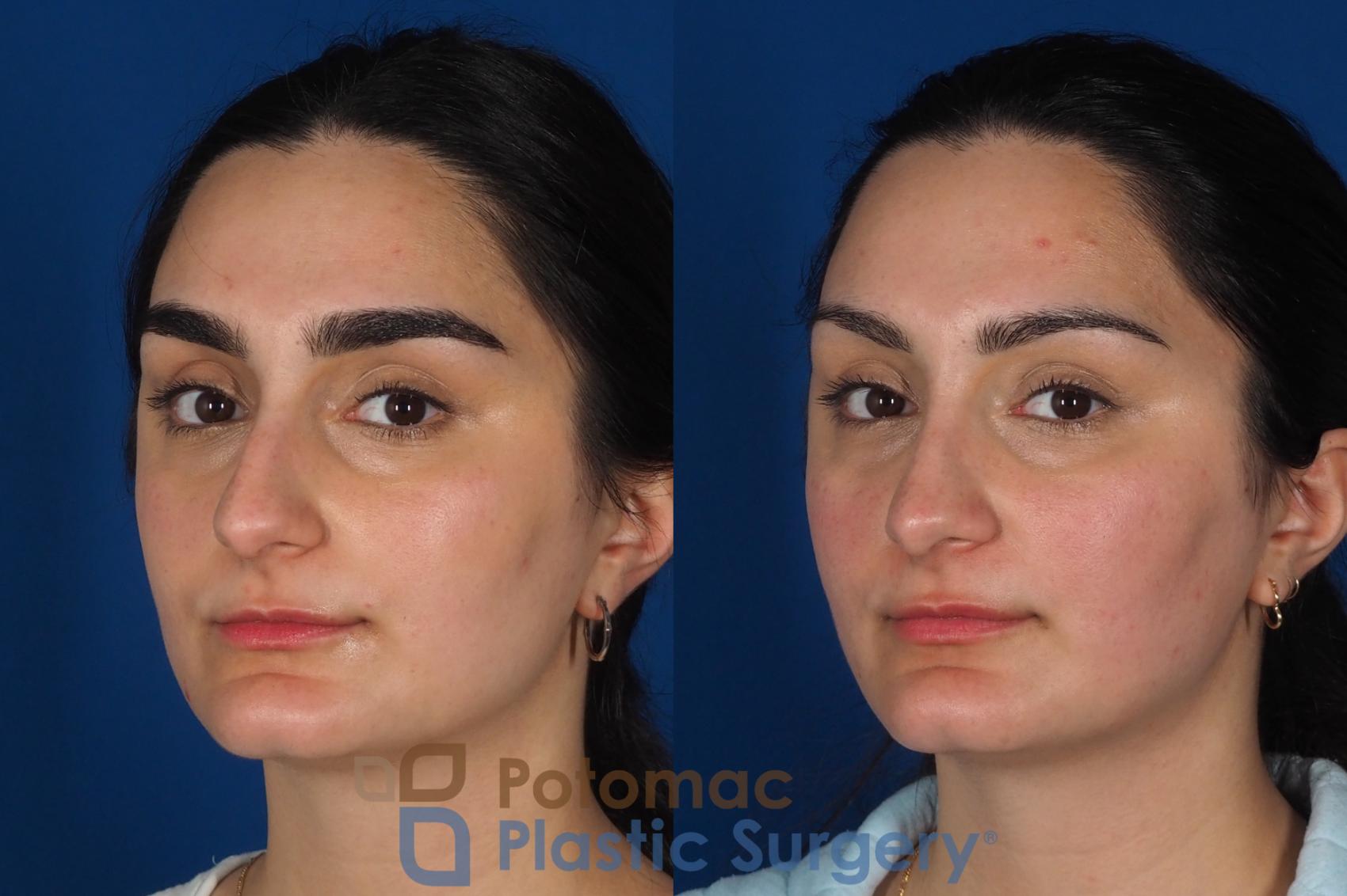 Before & After Rhinoplasty - Cosmetic Case 283 Left Oblique 2 View in Washington, DC