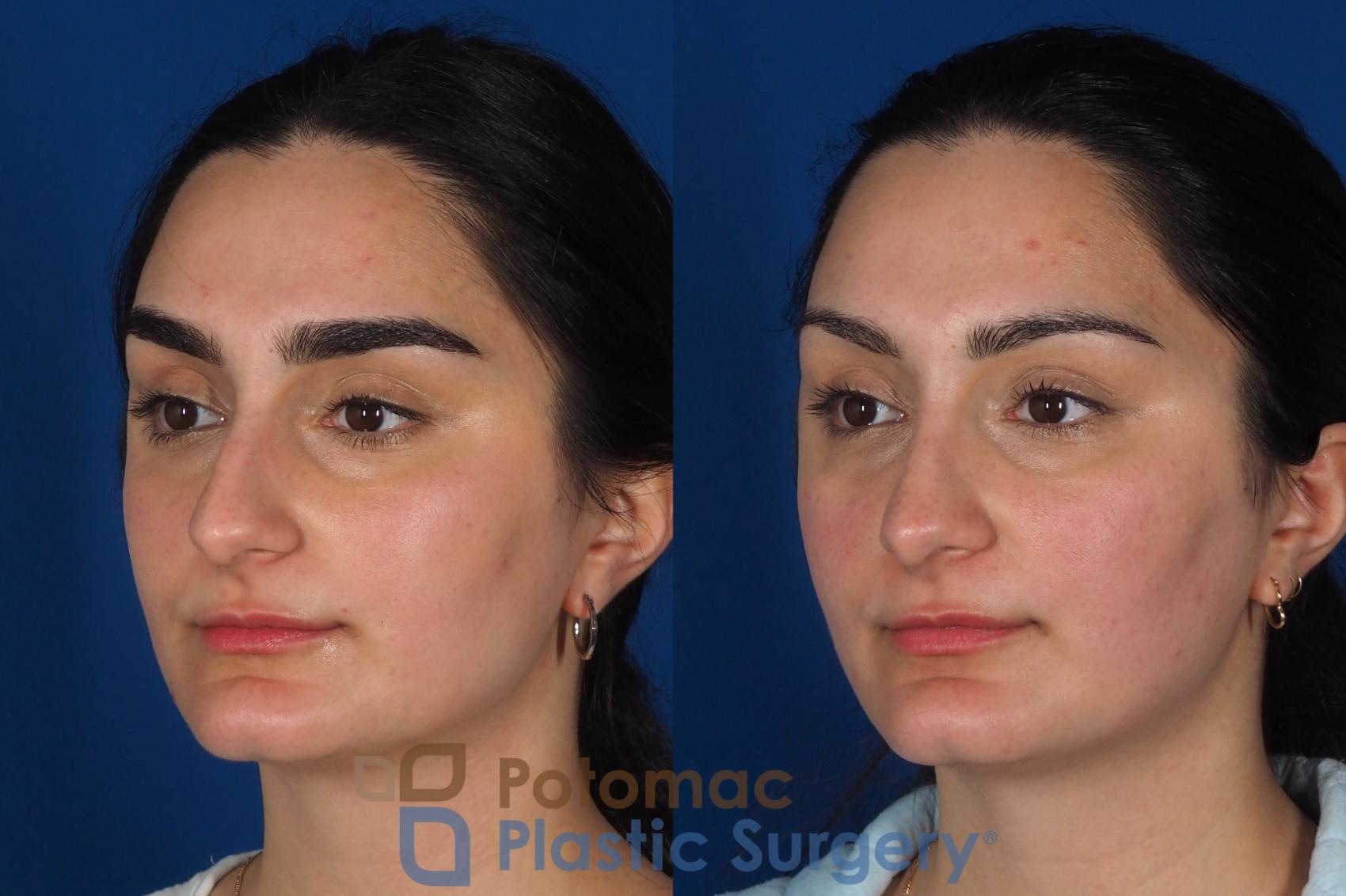 Before & After Rhinoplasty - Cosmetic Case 283 Left Oblique View in Washington, DC