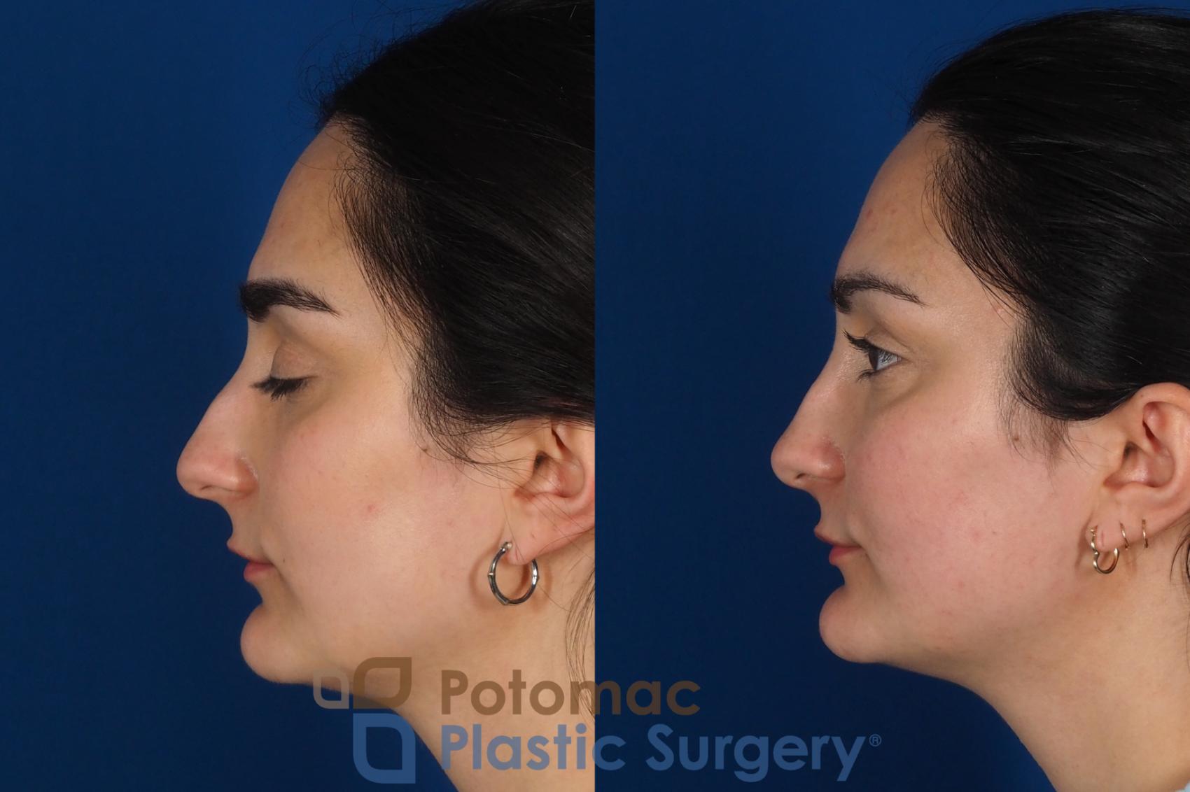 Before & After Rhinoplasty - Cosmetic Case 283 Left Side View in Washington, DC
