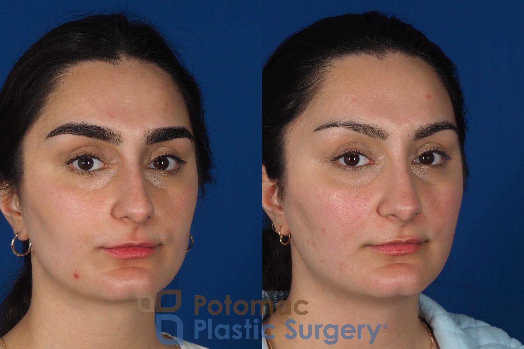 Before & After Rhinoplasty - Cosmetic Case 283 Right Oblique 2 View in Washington, DC