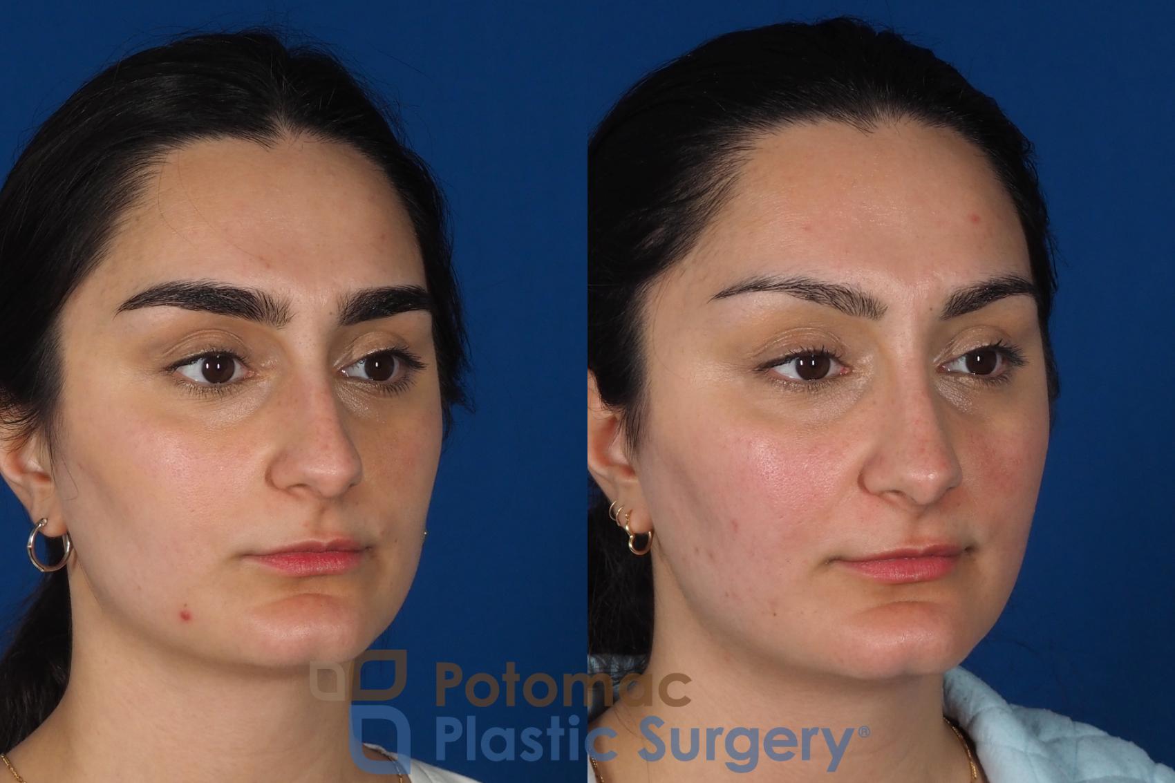 Before & After Rhinoplasty - Cosmetic Case 283 Right Oblique View in Washington, DC