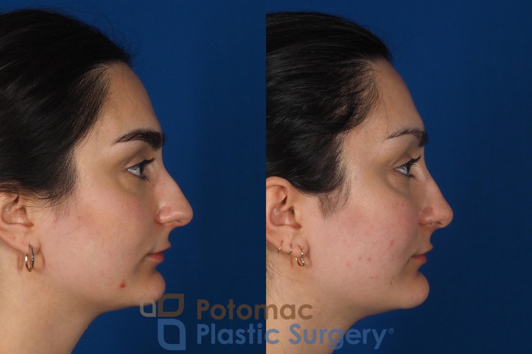 Before & After Rhinoplasty - Cosmetic Case 283 Right Side View in Washington, DC