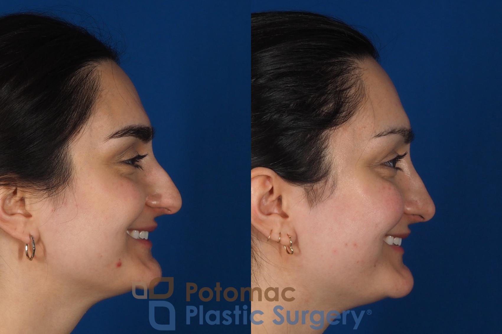 Before & After Rhinoplasty - Cosmetic Case 283 Right - Smiling View in Washington, DC