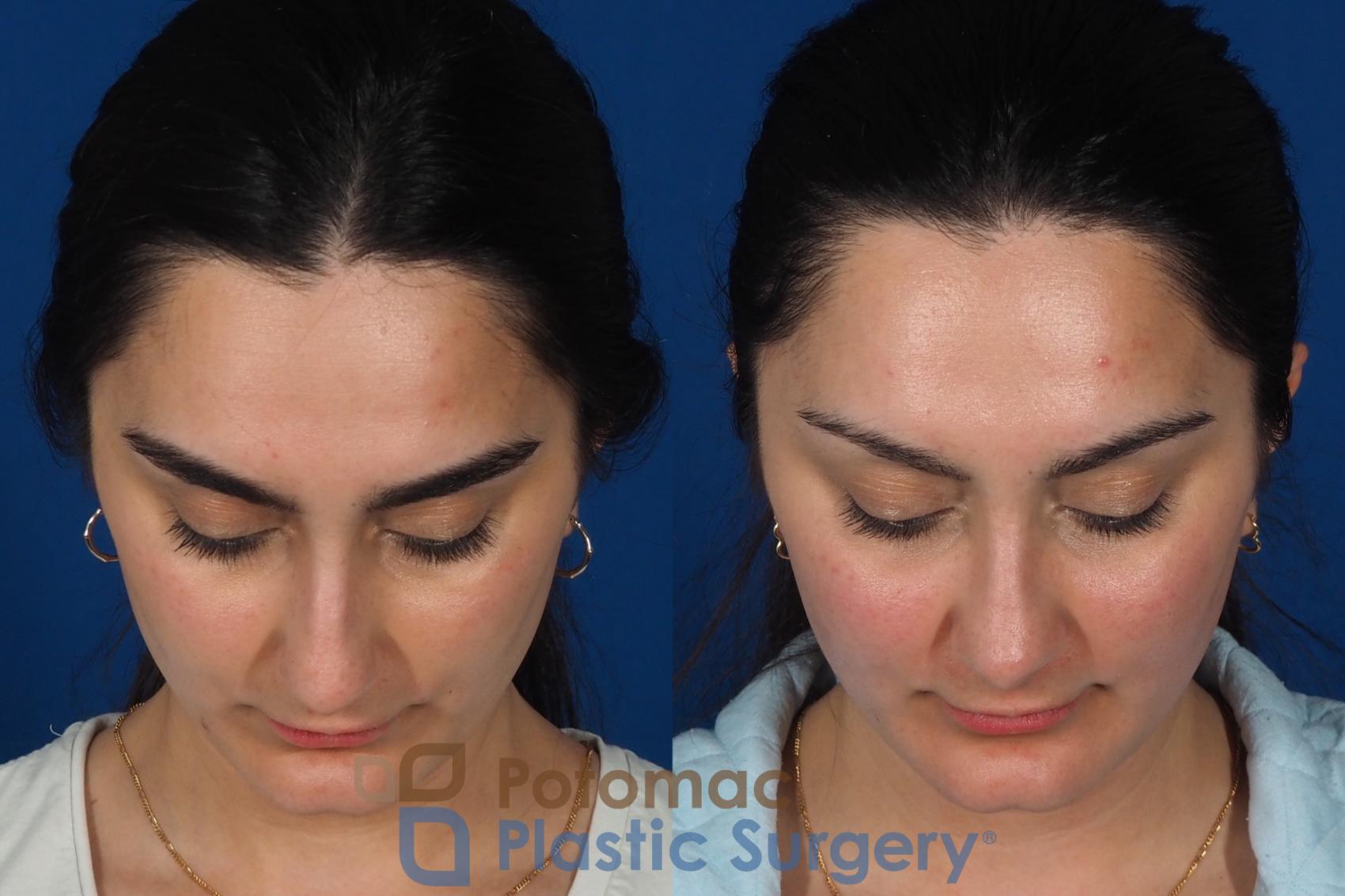 Before & After Rhinoplasty - Cosmetic Case 283 Top View in Washington DC & Arlington , DC