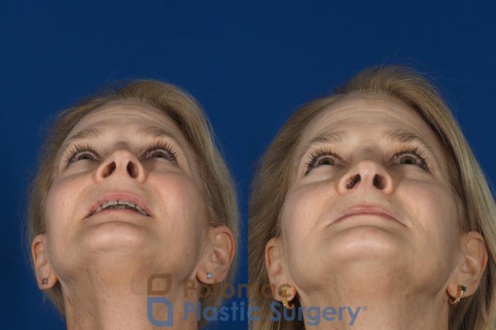 Before & After Rhinoplasty - Medical Case 284 Bottom View in Washington DC & Arlington , DC