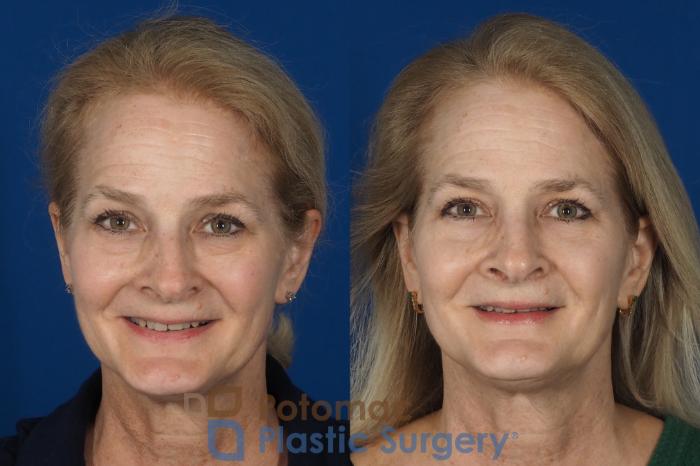 Before & After Rhinoplasty - Cosmetic Case 284 Front - Smiling View in Washington DC & Arlington , DC