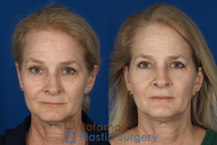 Before & After Rhinoplasty - Cosmetic Case 284 Front View in Washington DC & Arlington , DC