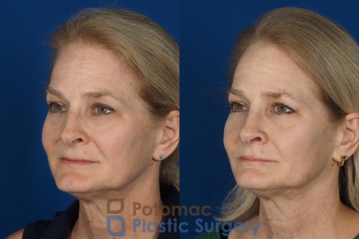 Before & After Rhinoplasty - Medical Case 284 Left Oblique View in Washington DC & Arlington , DC