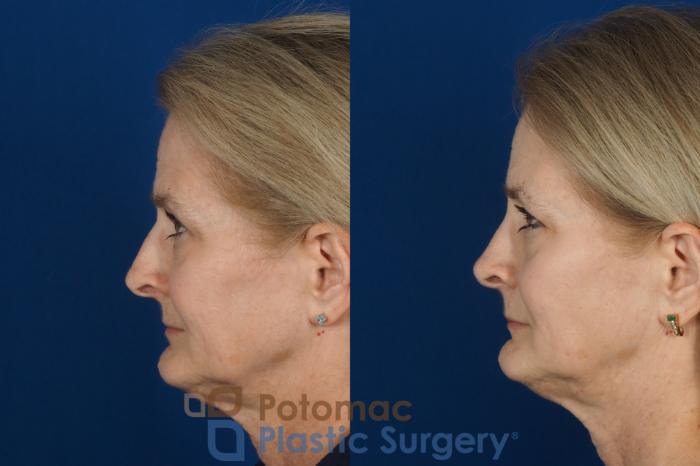 Before & After Rhinoplasty - Cosmetic Case 284 Left Side View in Washington DC & Arlington , DC