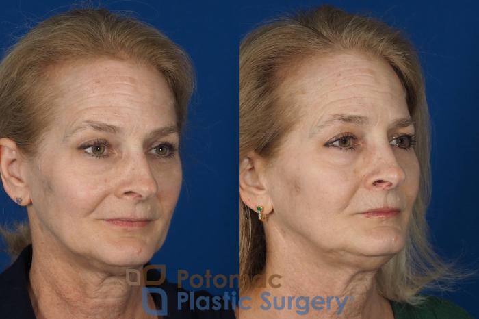 Before & After Rhinoplasty - Medical Case 284 Right Oblique View in Washington DC & Arlington , DC