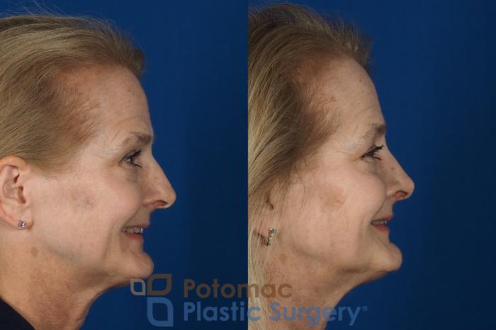 Before & After Rhinoplasty - Medical Case 284 Right Side - Smiling View in Washington DC & Arlington , DC