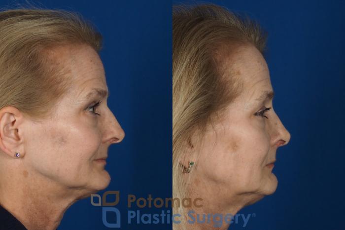 Before & After Rhinoplasty - Medical Case 284 Right Side View in Washington DC & Arlington , DC
