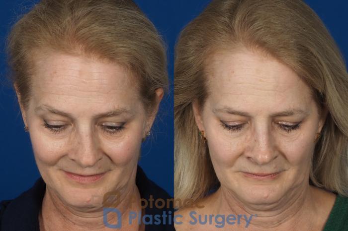 Before & After Rhinoplasty - Cosmetic Case 284 Top View in Washington DC & Arlington , DC