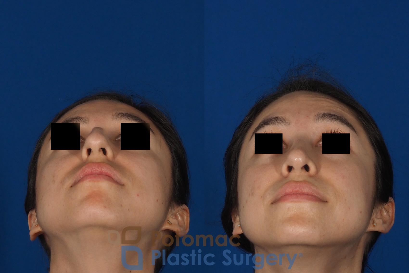 Before & After Rhinoplasty - Cosmetic Case 285 Bottom View in Washington DC & Arlington , DC