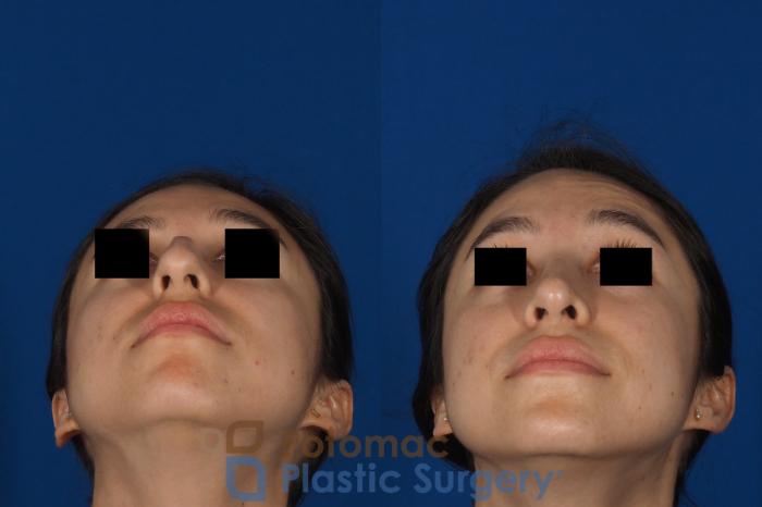 Before & After Rhinoplasty - Cosmetic Case 285 Bottom View in Washington, DC