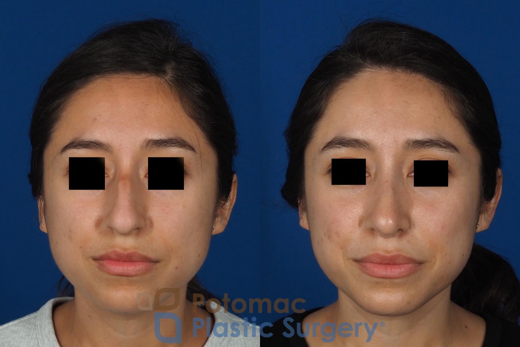 Before & After Rhinoplasty - Cosmetic Case 285 Front View in Washington DC & Arlington , DC