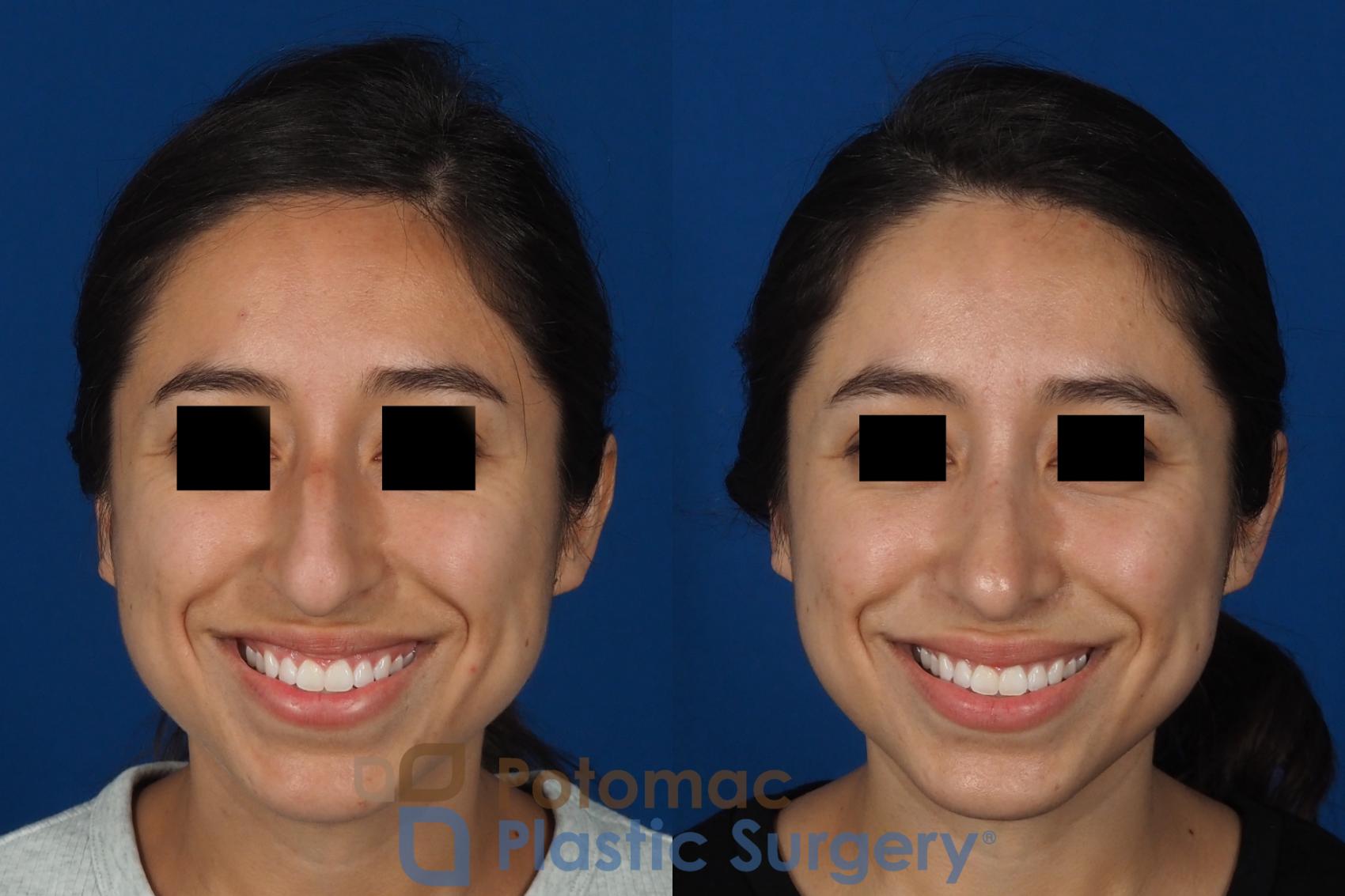 Before & After Rhinoplasty - Cosmetic Case 285 Front - Smiling View in Washington DC & Arlington , DC