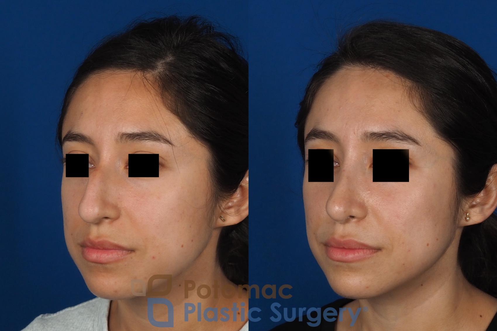 Before & After Rhinoplasty - Cosmetic Case 285 Left Oblique View in Washington DC & Arlington , DC