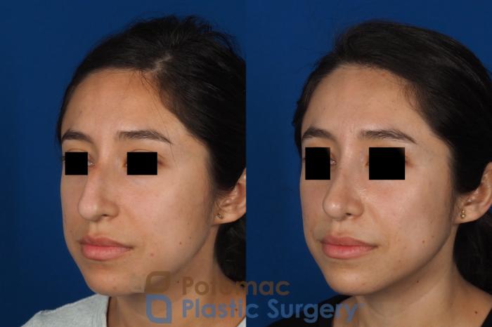 Before & After Rhinoplasty - Cosmetic Case 285 Left Oblique View in Washington, DC