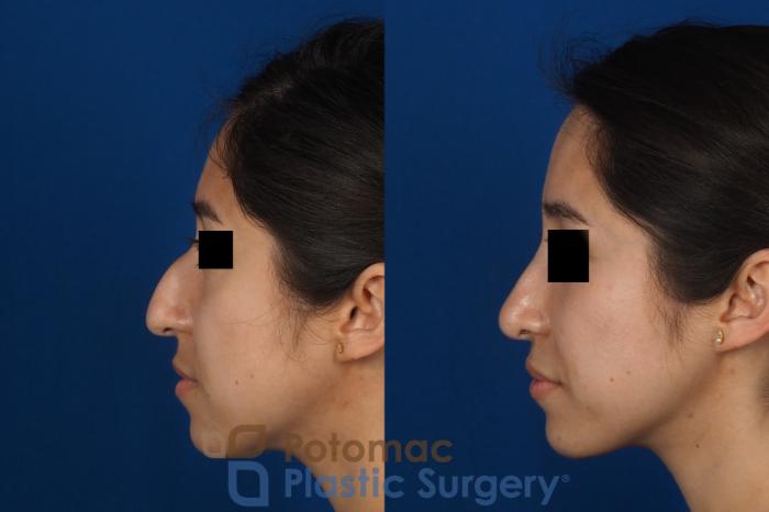 Before & After Rhinoplasty - Cosmetic Case 285 Left Side View in Washington, DC