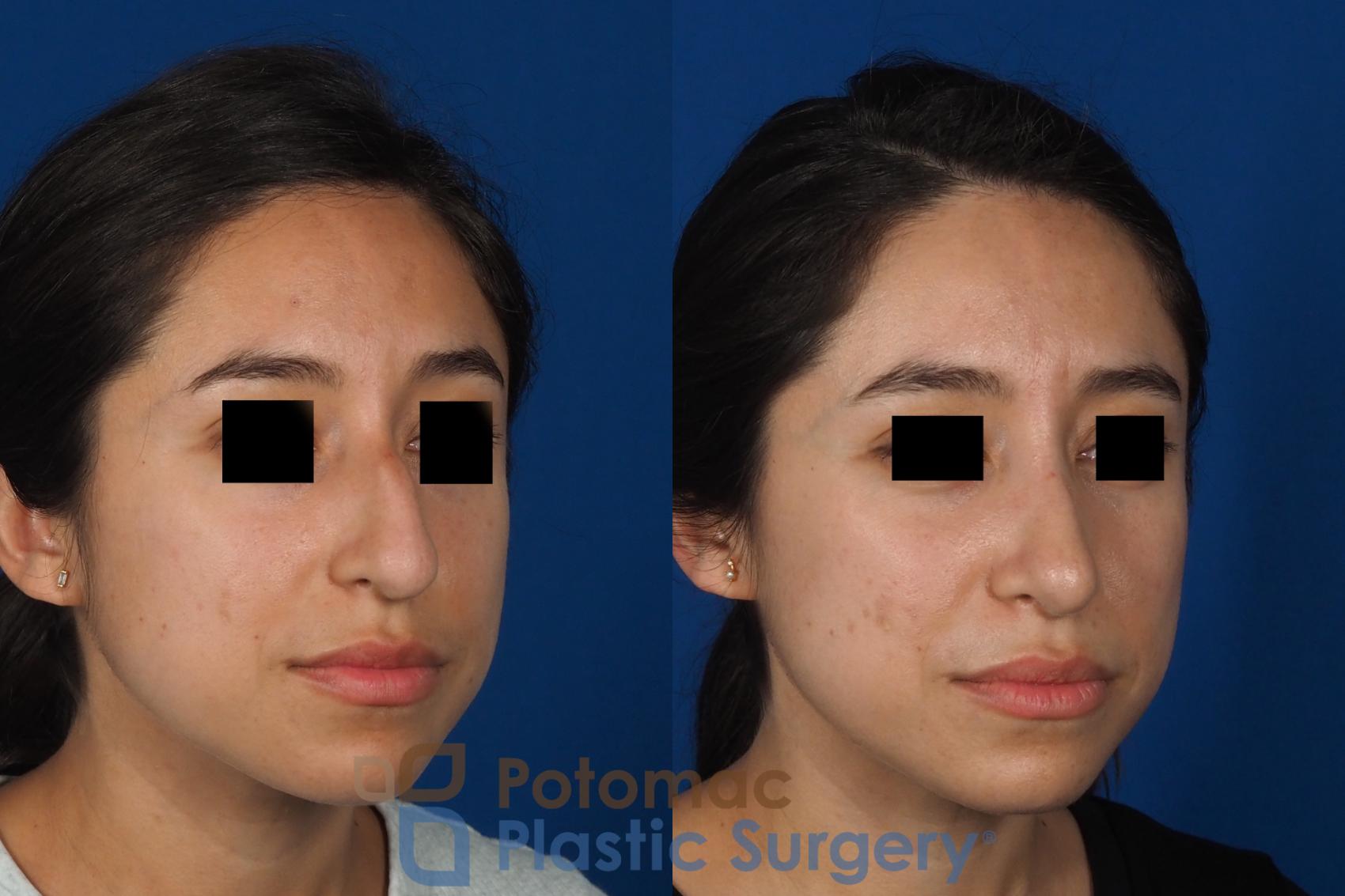 Before & After Rhinoplasty - Cosmetic Case 285 Right Oblique View in Washington DC & Arlington , DC