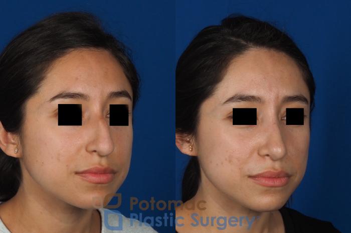 Before & After Rhinoplasty - Cosmetic Case 285 Right Oblique View in Washington, DC