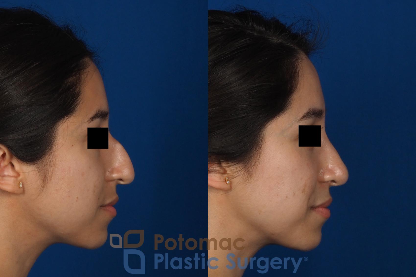 Before & After Rhinoplasty - Cosmetic Case 285 Right Side View in Washington, DC