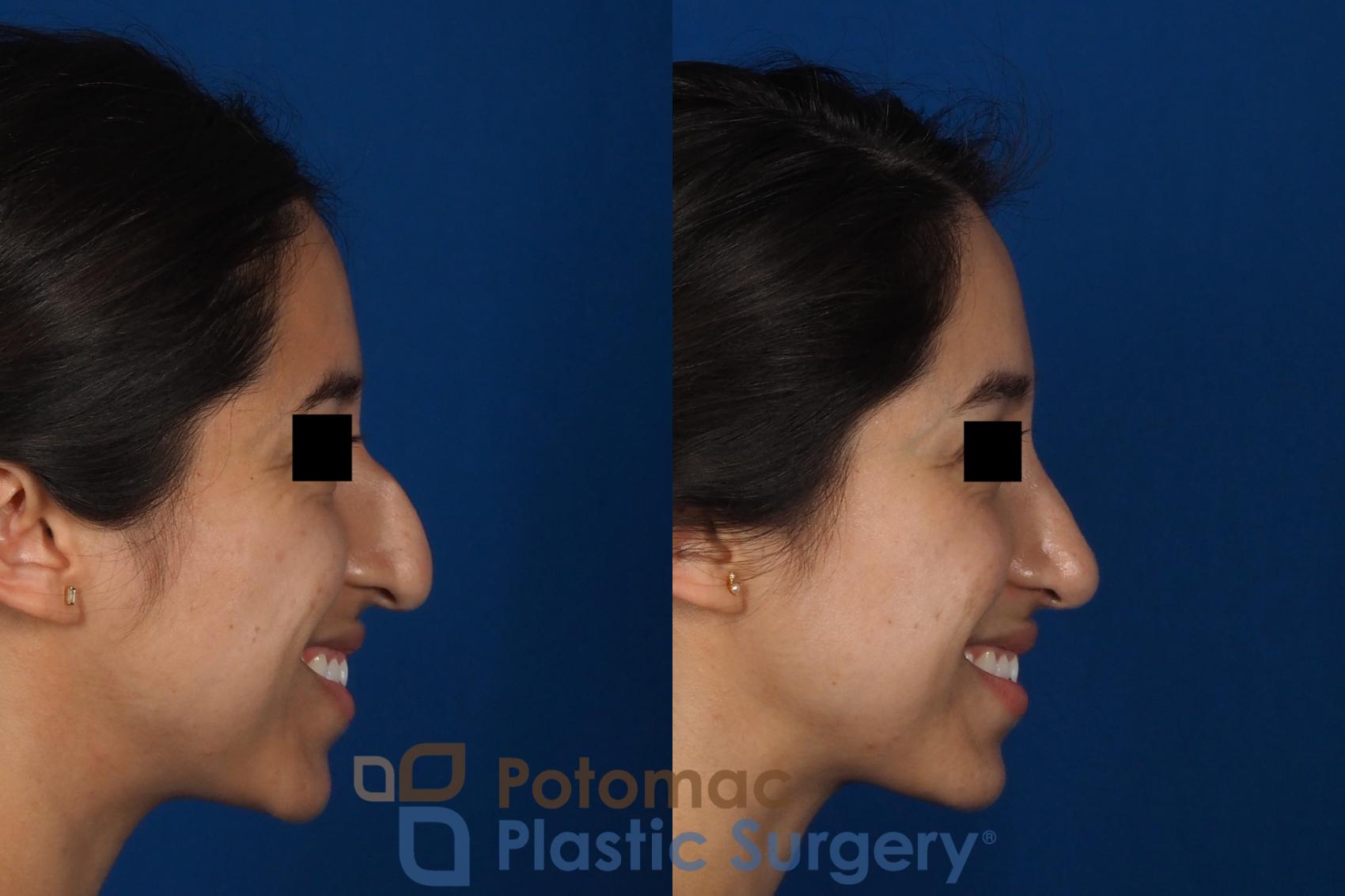 Before & After Rhinoplasty - Cosmetic Case 285 Right - Smiling View in Washington DC & Arlington , DC