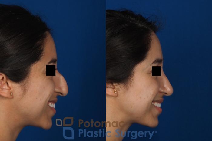 Before & After Rhinoplasty - Cosmetic Case 285 Right - Smiling View in Washington, DC