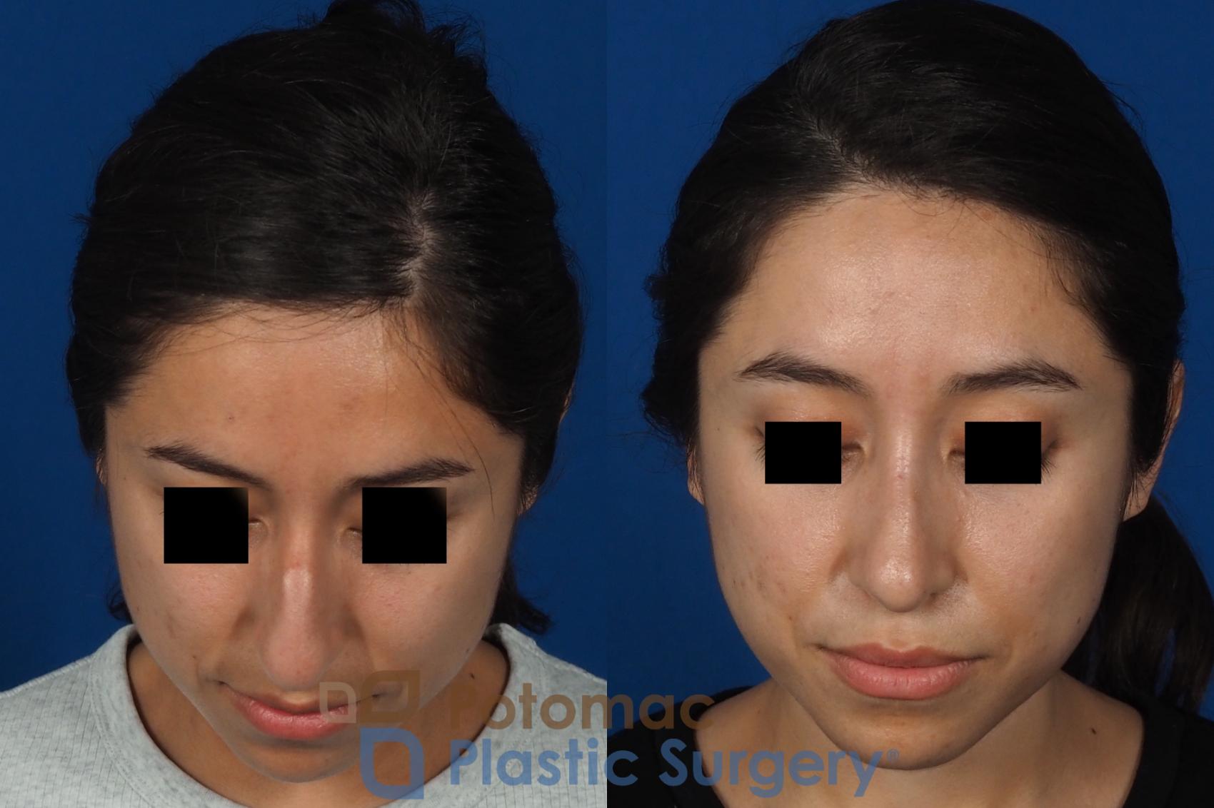 Before & After Rhinoplasty - Cosmetic Case 285 Top View in Washington DC & Arlington , DC
