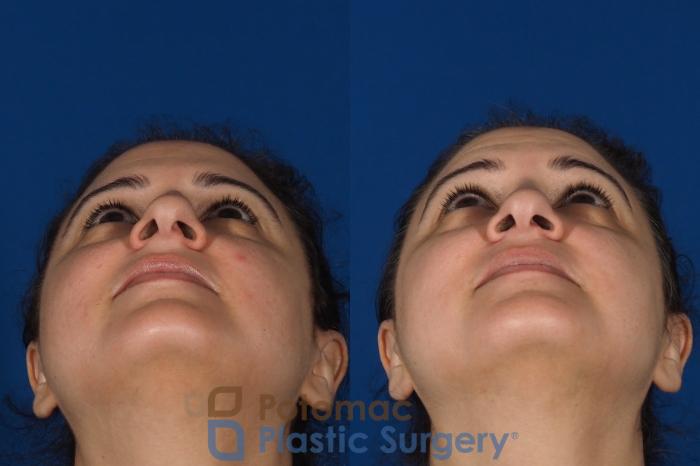 Before & After Rhinoplasty - Cosmetic Case 287 Bottom View in Arlington, VA & Washington, DC