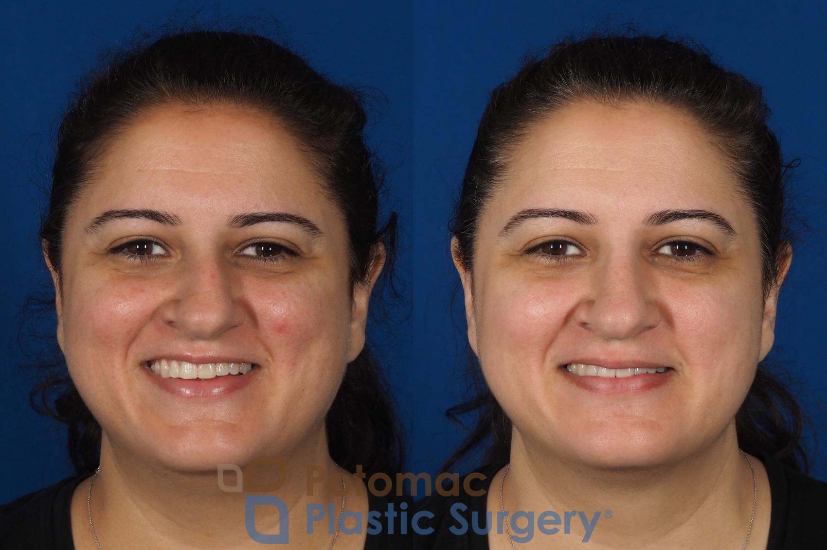 Before & After Rhinoplasty - Cosmetic Case 287 Front - Smiling View in Washington, DC