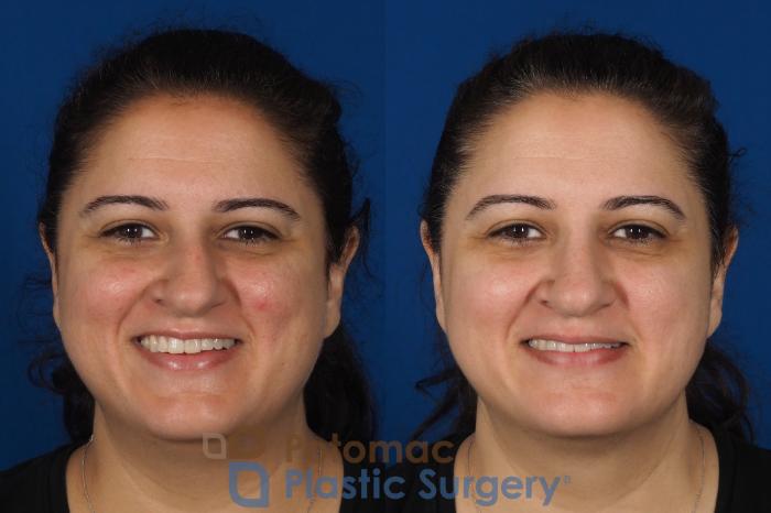 Before & After Rhinoplasty - Cosmetic Case 287 Front - Smiling View in Arlington, VA & Washington, DC