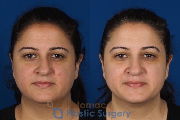 Before & After Rhinoplasty - Cosmetic Case 287 Front View in Arlington, VA & Washington, DC