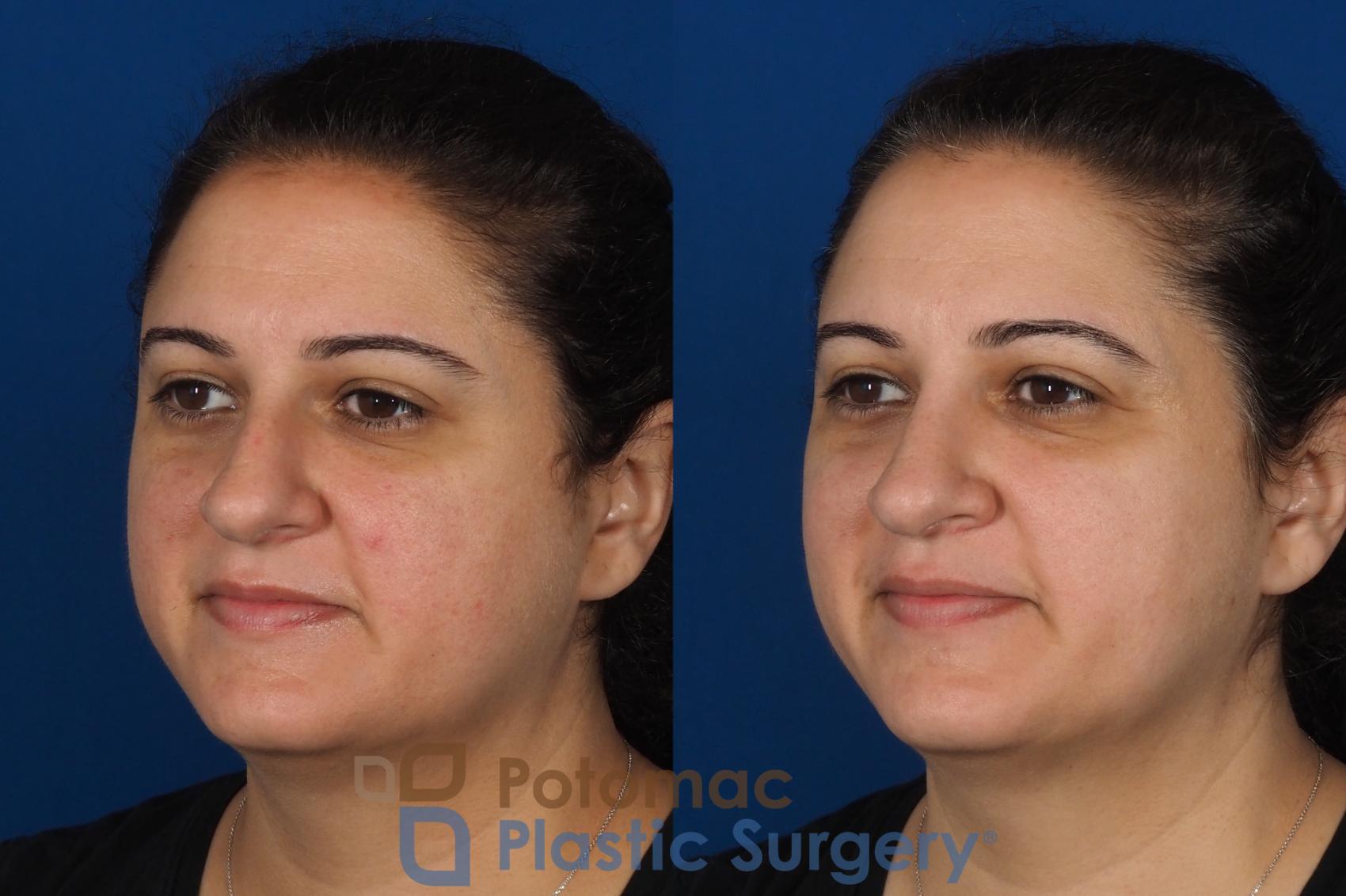 Before & After Rhinoplasty - Cosmetic Case 287 Left Oblique View in Washington, DC